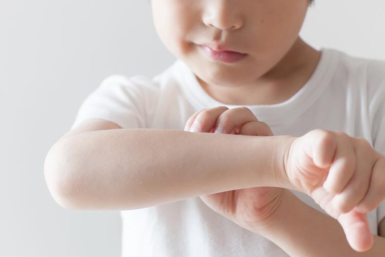 アトピー性皮膚炎のイメージ画像