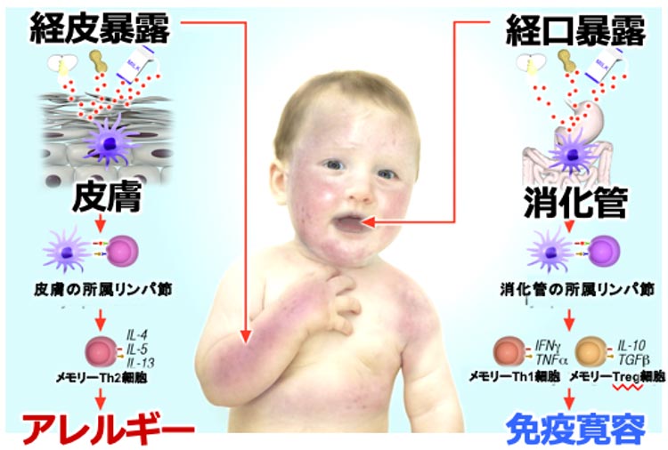 図2 Lack G : J Allergy Clin Immunol.