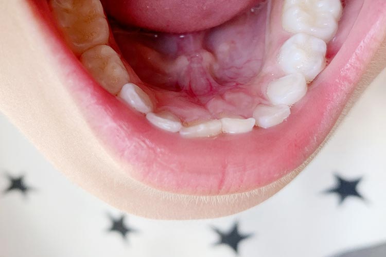 アレルギー性鼻炎・舌下免疫療法のイメージ画像